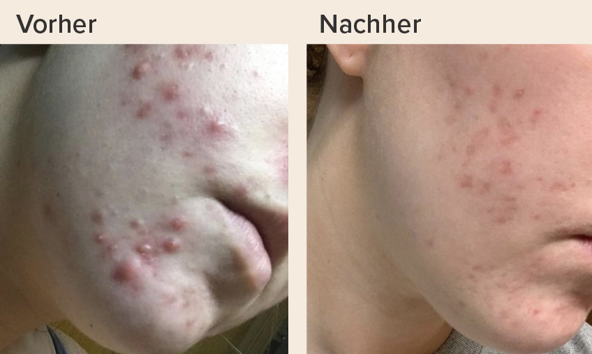 Acne-solution